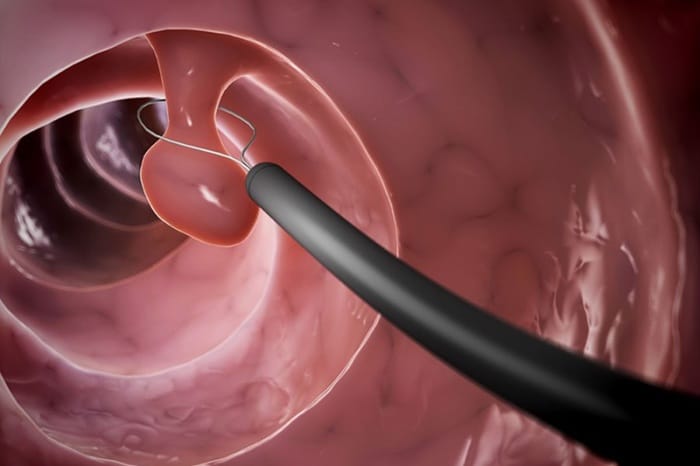 Polyp có kích thước lớn, to cần phải điều trị sớm