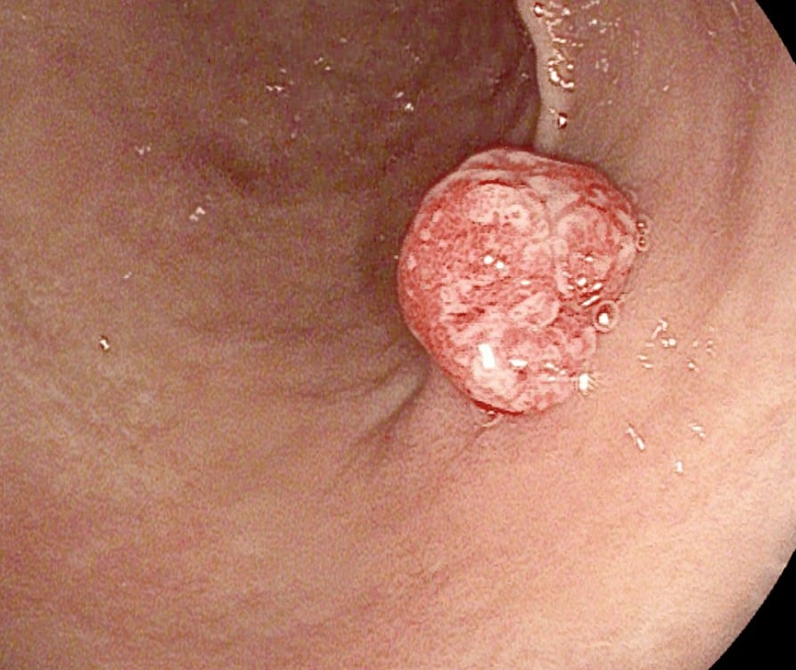 Polyp dạ dày không cuống bám chặt vào niêm mạc