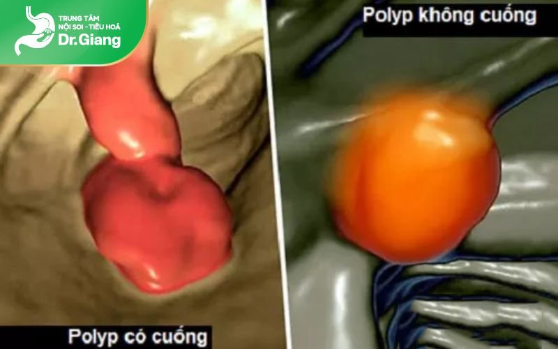 Sự khác biệt giữa polyp dạ dày có cuống và không cuống