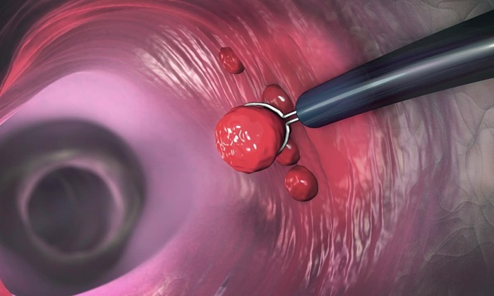 Polyp dạ dày là gì? nguyên nhân và cách điều trị