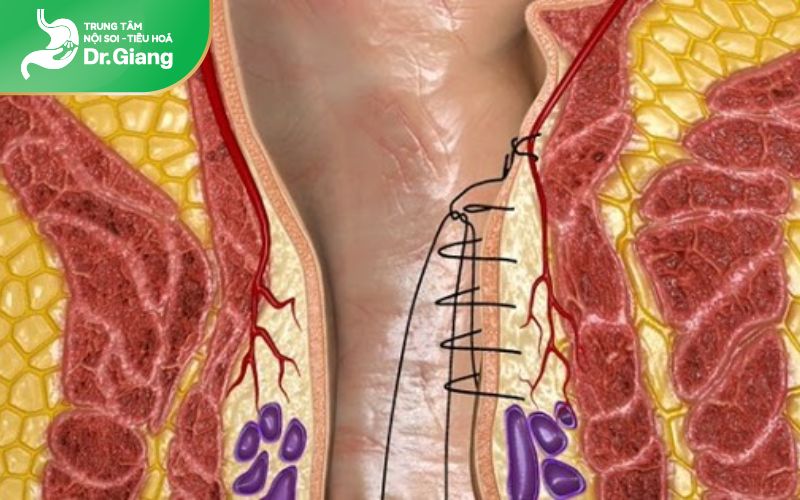 Triệt mạch bằng siêu âm Doppler - THD