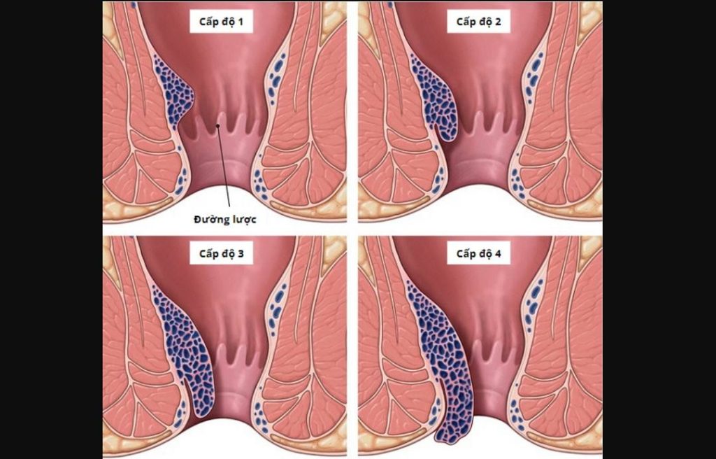 Nhận biết 4 cấp độ trĩ