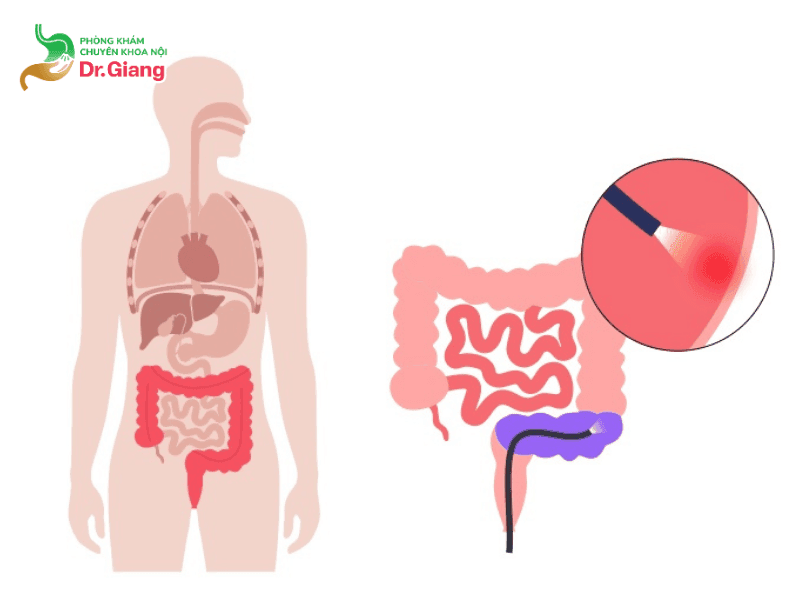 Nội soi đường ruột giúp bác sĩ chẩn đoán chính xác các tổn thương ở đường tiêu hóa