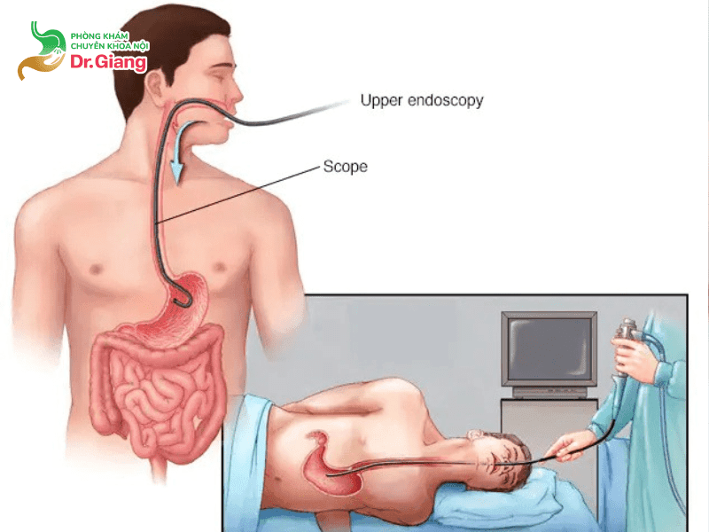 Phương pháp nội soi thực quản bằng ống mềm qua đường miệng