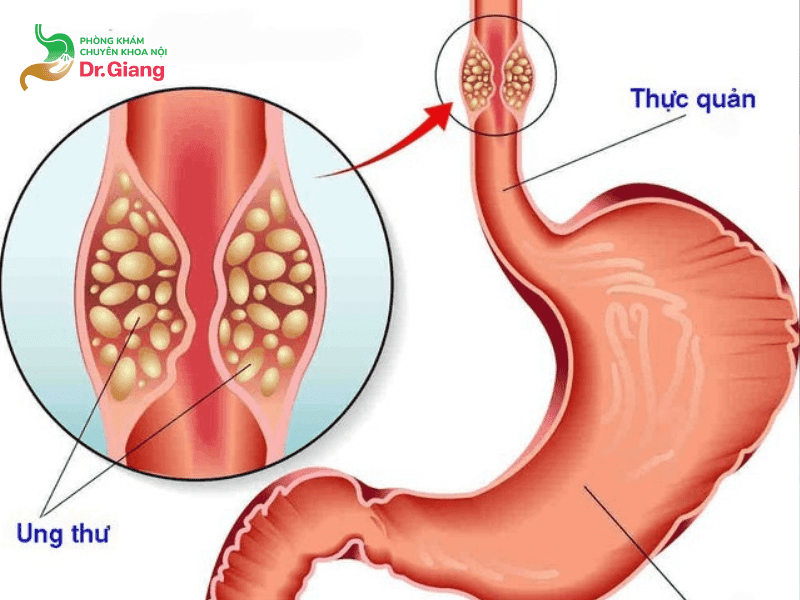 Nội soi thực quản phát hiện ung thư nhanh chóng