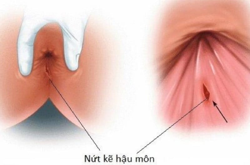 Nứt kẽ hậu môn có thể điều trị khỏi