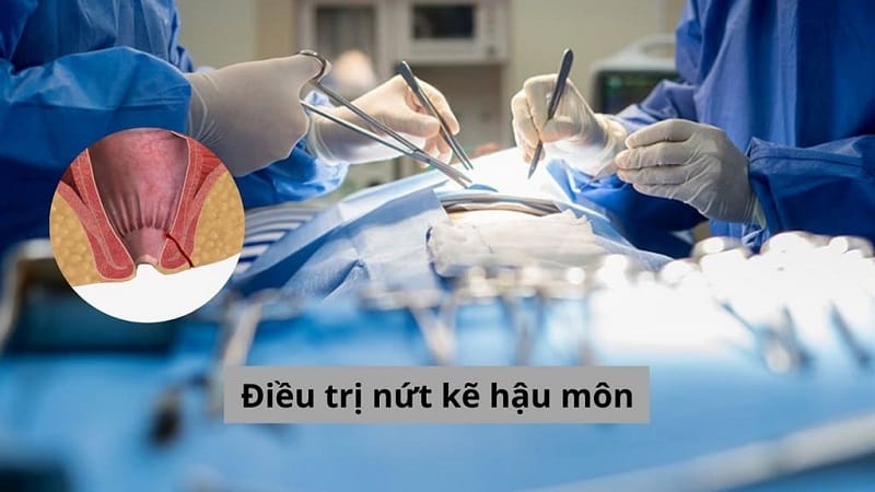 Phẫu thuật được chỉ định để điều trị dứt điểm nứt kẽ hậu môn mãn tính