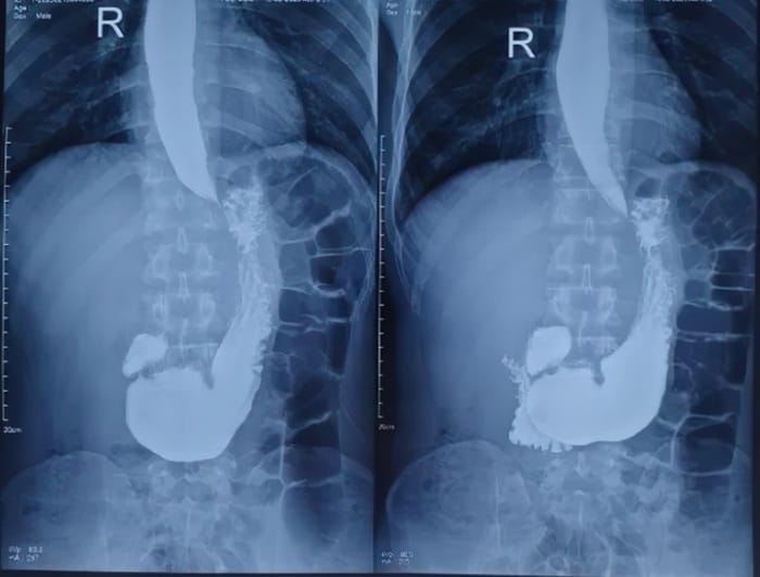 Chụp X-quang dạ dày có cản quang giúp phát hiện tổn thương lớn