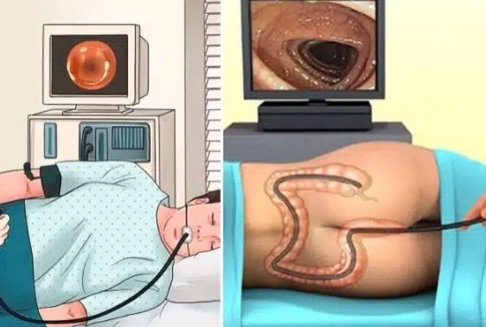 nội soi kép không làm tăng nguy cơ biến chứng
