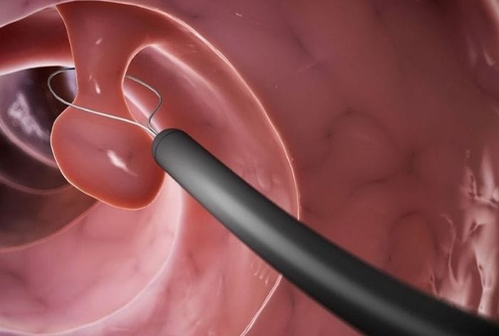 Người có tiền sử cắt polyp dạ dày