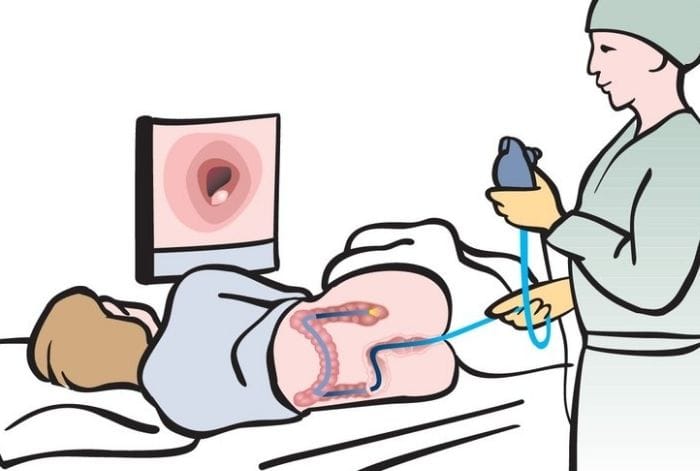 Người bình thường nên nội soi đại tràng 5 năm/lần