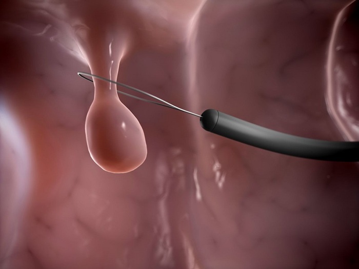 Tùy thuộc vào vị trí, kích thước polyp mà thời gian lành khác nhau