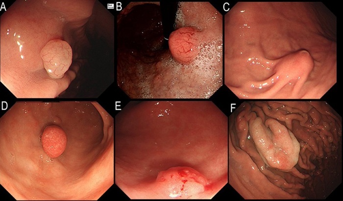 Vị trí polyp ở dạ dày, đại tràng ảnh hưởng tới thời gian lành vết thương