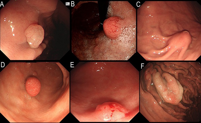 Tùy thuộc kích thước polyp sẽ ảnh hưởng tới mức độ đau