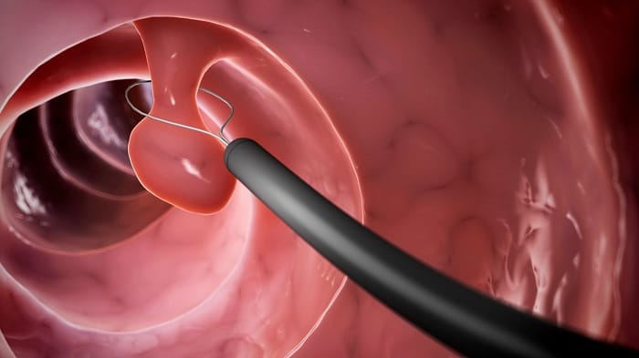 Không có con số cụ thể về cắt polyp đại tràng