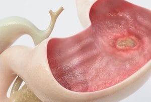 Điều trị loét dạ dày bao lâu thì khỏi? Cách rút ngắn thời gian phục hồi