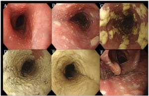 Hình ảnh trào ngược dạ dày qua nội soi: Dấu hiệu nhận biết và chẩn đoán
