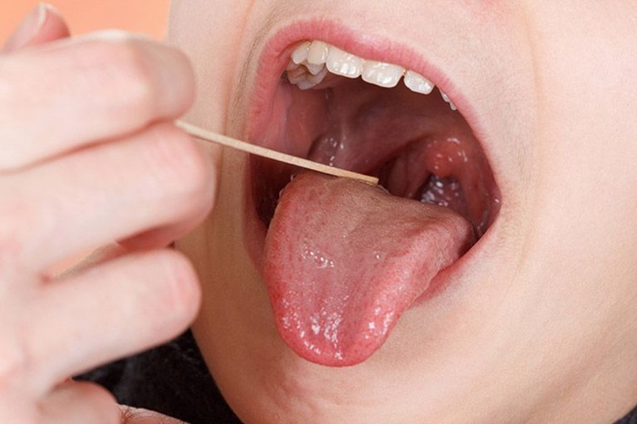 Có thể nhìn thấy rõ sưng đỏ họng do trào ngược dạ dày gây nên