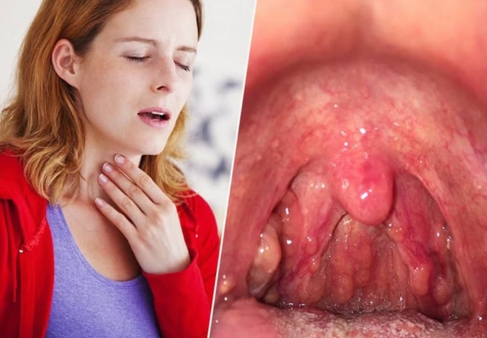 Họng đỏ, sưng phù nề thanh quản khi bị trào ngược dạ dày