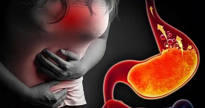 Người bệnh nên thăm khám trào ngược dạ dày sớm