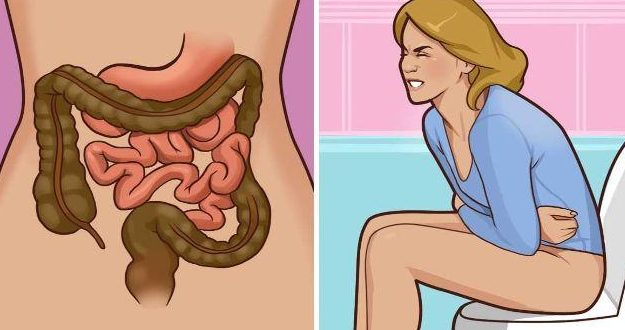 Người bệnh ở độ tuổi trung niên, thường xuyên có biểu hiện bất thường như đau bụng, táo bón