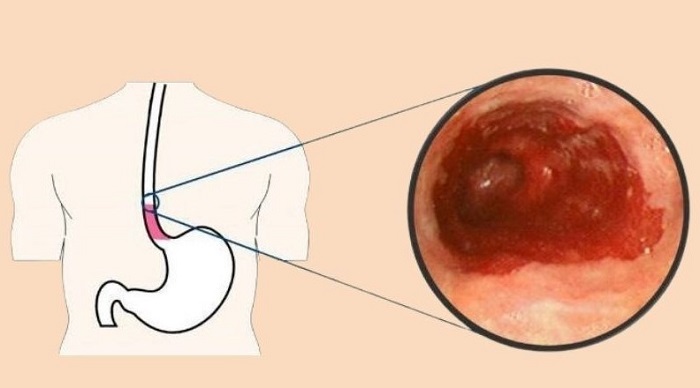 Dạ dày có thể bị viêm loét nghiêm trọng