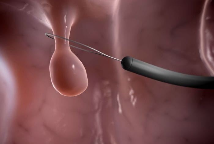 Sau khi cắt polyp