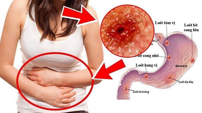 Nội soi dạ dày sớm để có thể điều trị các bệnh tiêu hóa