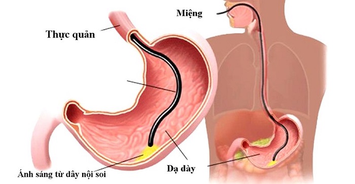 Khi nội soi dạ dày sẽ nhận biết được bệnh ung thư giai đoạn đầu