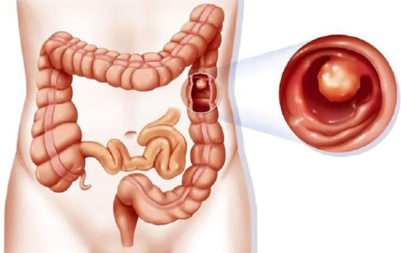 Khi nội soi đại tràng có thể phát hiện được tế bào ung thư