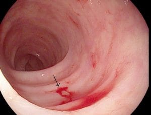 Nội soi đại tràng có ảnh hưởng gì không? Những biến chứng có thể gặp