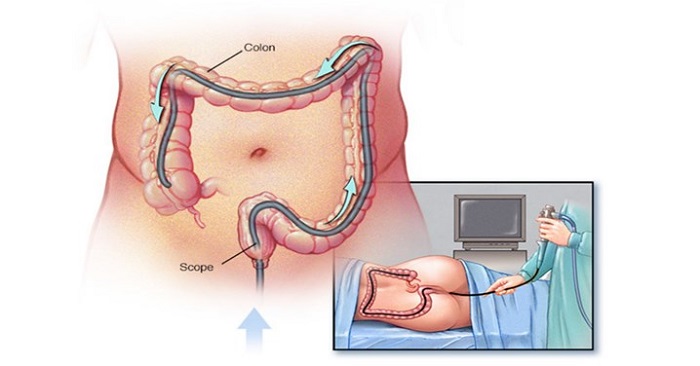 Lạm dụng nội soi đại tràng nhiều lần gây ảnh hưởng đến sức khỏe, nếu không được thực hiện đúng cách