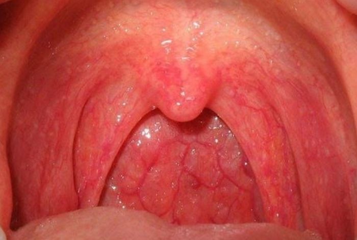 Nội soi họng định kỳ