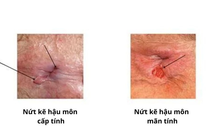 Tùy thuộc mức độ vết nứt hậu môn mà thời gian lành khác nhau