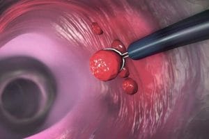 Polyp dạ dày có nên cắt không? khi nào không nên cắt