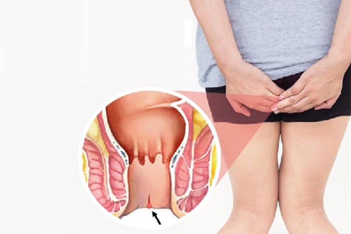 Nứt kẽ hậu môn có thể do vệ sinh không đúng cách gây ra