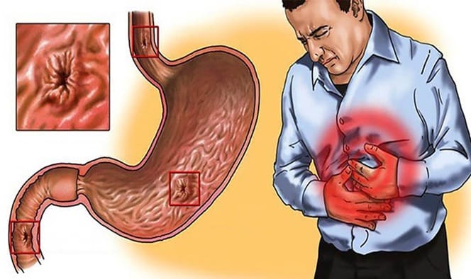 Người đau dạ dày cấp không nên ăn sữa chua