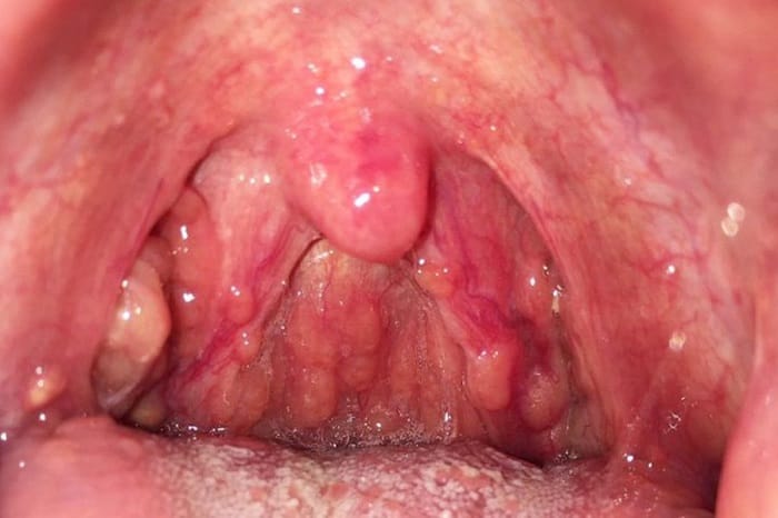 Họng khó nuốt, nghẹn cũng là triệu chứng trào ngược dạ dày