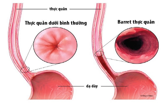 Nôn ra máu cũng có thể cảnh báo bệnh nghiệm trọng 