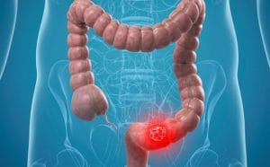 Ung thư ruột non sống được bao lâu? các yếu tố ảnh hưởng