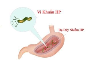 Vi khuẩn HP gây trào ngược dạ dày? một số triệu trứng thường gặp