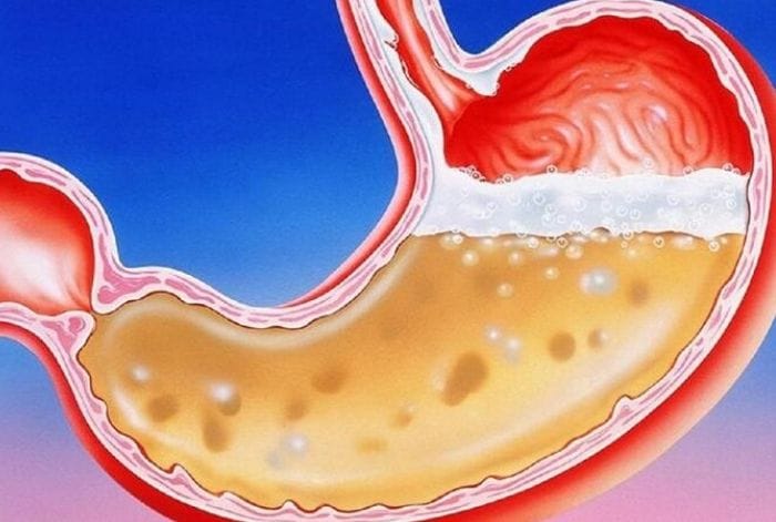 Uống sữa khi viêm đại tràng có thể làm tăng tiết dịch vị