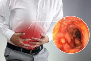 5 Triệu chứng viêm đại tràng thường gặp nhiều nhất