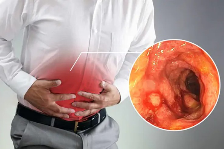 5 Triệu chứng viêm đại tràng thường gặp nhiều nhất