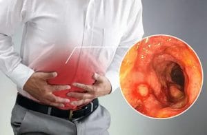 8 Dấu hiệu viêm đại tràng cấp tính bạn cần biết