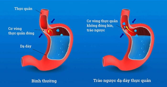 Trào ngược dạ dày được biết đến là tình trạng vòng thực quản yếu