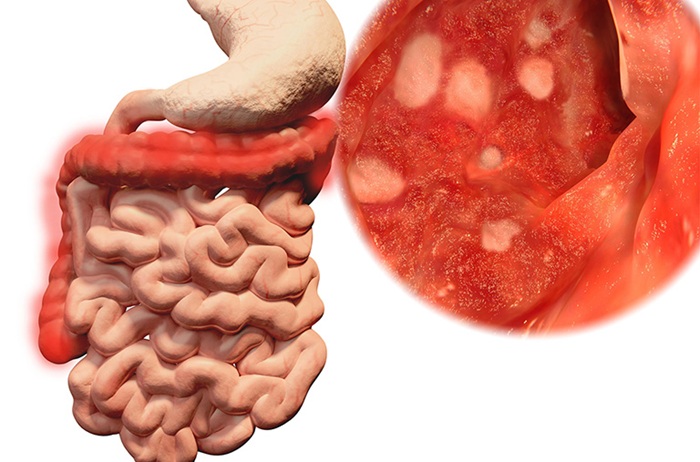 Viêm đại tràng là gì? nguyên nhân gây viêm đại tràng và cách điều trị