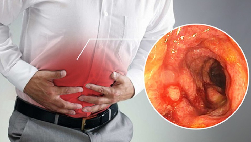 Viêm trực tràng là gì?Nguyên nhân gây viêm trực tràng