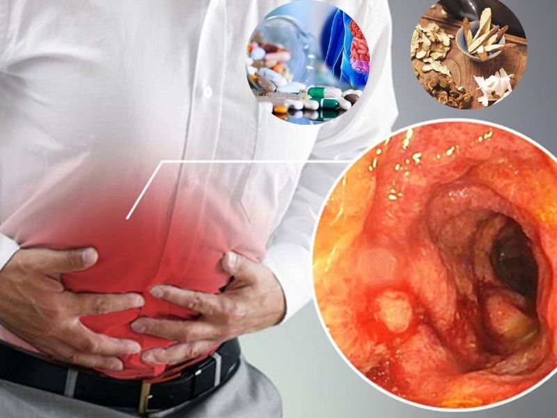 Điều trị viêm đại tràng mãn tính? Gợi ý 5 phương pháp điều trị hiệu quả mãn tính