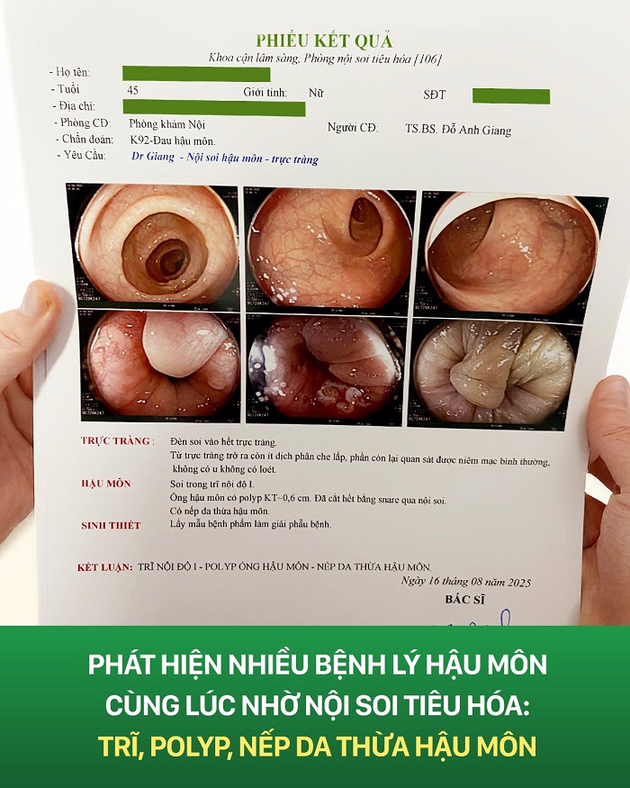 Quá trình nội soi tiêu hóa có thể phát hiện được nhiều bệnh lý